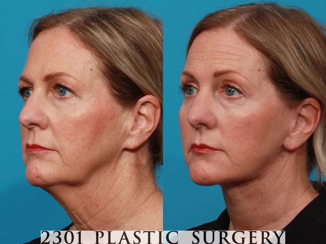 Face Lift Before & After
