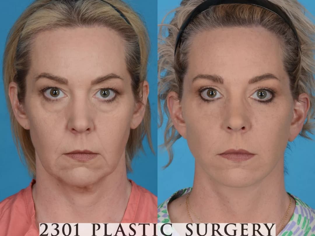 Face Lift Before & After