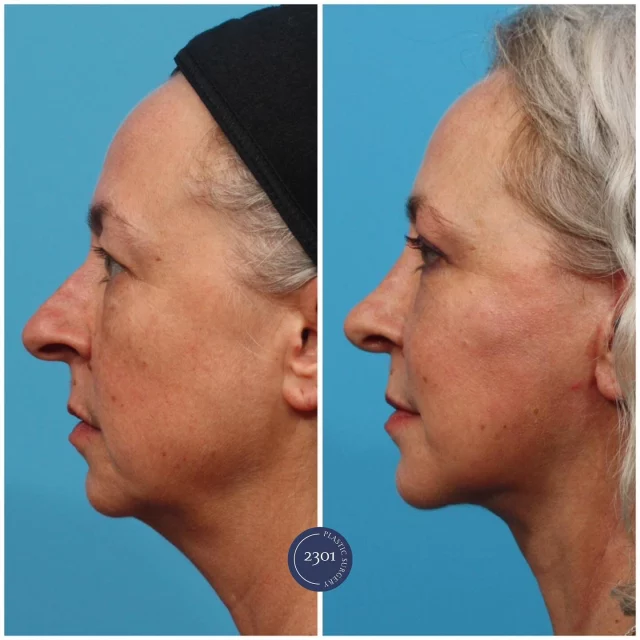 ✨ Our beautiful patient is loving her stunning results after a Facelift , Neck lift and Rhinoplasty. A refreshed, rejuvenated look that enhances her natural beauty. The confidence boost is real! 

Surgeon- Dr. Michael Bogdan, MD, FACS, Board Certified

Surgery- Facelift|Rhinoplasty|Neck lift

📞817-442-1236
🔗https://www.2301plasticsurgery.com

#FaceliftResults #RhinoplastyTransformation #GlowUp #BeautyByDesign #ConfidenceIsKey #2301plasticsurgery #plasticsurgeon #westgateplasticsurgery