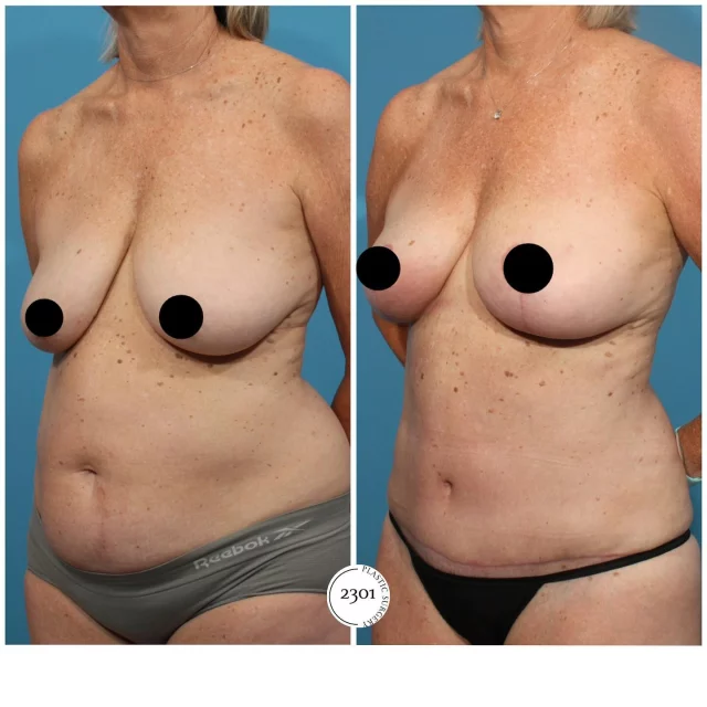 Transforming confidence, one procedure at a time! 🌟 Check out this stunning before and after of a Tummy tuck, Breast lift, and Liposuction. Our patient is beyond thrilled with her results—and we couldn’t be happier for her! Ready for your own transformation? Come see us at 2301 Plastic Surgery. 🤩

Surgeon- Dr. Michael Bogdan, MD, FACS, Board certified🥼

Surgery- Abdominoplasty, Liposuction, Breast lift✨👏

🔗https://www.2301plasticsurgery.com
📞817-442-1236

#ConfidenceRestored #TummyTuck #BreastLift #Liposuction #BeforeAndAfter #Transformation #PlasticSurgeryJourney