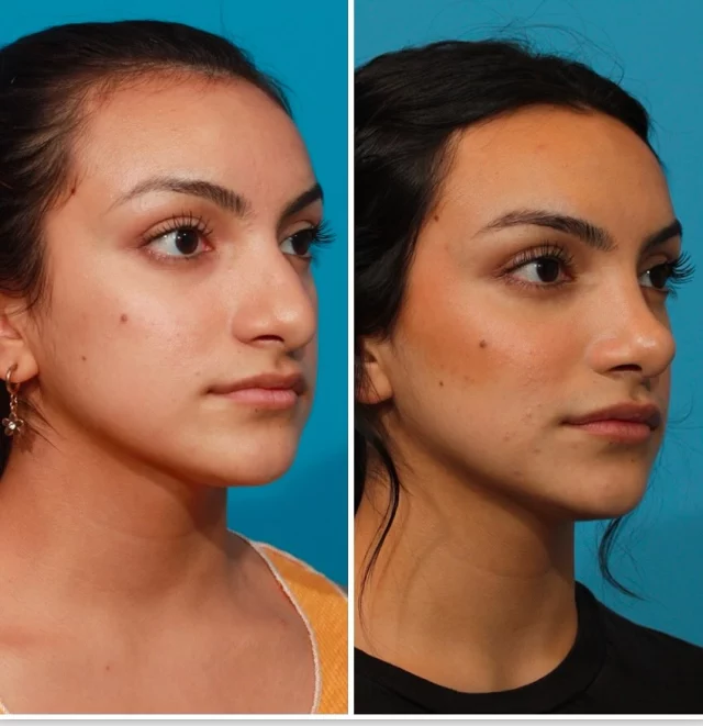 Check out this stunning before and after of our patient’s rhinoplasty! She’s absolutely loving her results. The procedure beautifully refined her profile by removing the dorsal hump, creating a smoother, more balanced appearance. We’re so thrilled to see how confident she feels with her new look!✨

Surgery- Rhinoplasty 👃

Surgeon- Dr. Michael Bogdan, MD🥼

🔗https://www.2301plasticsurgery.com

📞817-224-1236

#plasticsurgeon #dfw #rhinoplasty #confidence #plasticsurgery #wonderfulresults #beauty #drbogdan #2301plasticsurgery #nose