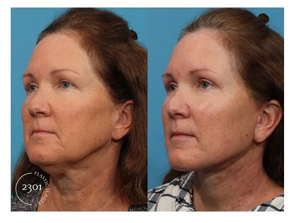 ✨ Our patient is glowing with confidence after her upper Blepharoplasty, and Face / Neck lift. The results speak for themselves – a more youthful, refreshed appearance that brings out her natural beauty.🌟 Ready to feel rejuvenated? Let’s make it happen!

📱817-442-1236
🔗https://www.2301plasticsurgery.com

Surgery- Upper Blepharoplasty|Face lift|Neck lift🪄

Surgeon- Dr. Michael Bogdan, MD🥼

@drmichaelbogdan 

 #Transformation #Rejuvenation #Facelift #Blepharoplasty #ConfidenceBoost #BeforeAndAfter #2301plasticsurgery #plasticsurgery #results #dfwplasticsurgeon