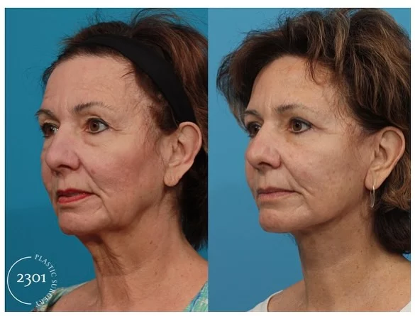 ✨ A face and neck lift combined with upper and lower blepharoplasty has brought out her natural radiance. She’s absolutely in love with the results! 

Surgeon- Dr. Michael Bogdan, MD

☎️ 817-442-1236 give us a call to book a consultation!

#FaceLift #NeckLift #Blepharoplasty #BeautyRedefined #Transformation